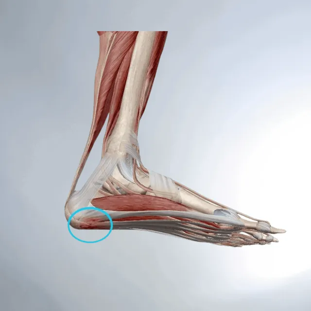 Plantar Fasiit Nedir? Topuk Ağrısına Yaklaşım